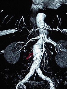 Abdominal aortic aneurysms (3,4 cm) Abdominal aortic aneurysm.JPG