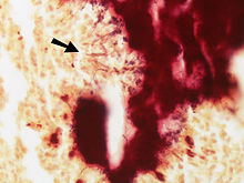 Thin Gram positive filamentous organisms seen at the periphery of the colony (lower)