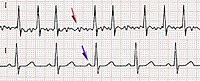 Fibrillazione atriale: è una patologia elettrica degli atri, che presenta costantemente una caratteristica: l'attivazione elettrica rapida e apparentemente caotica del tessuto atriale. Il tracciato superiore mostra le fini onde della fibrillazione (freccia) e assenza dell'onda P, in contrapposizione all'isoelettrica "pulita" del ritmo sinusale nel secondo tracciato, che evidenzia la presenza dell'onda P (freccia).[53]