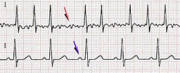 Afib ecg.jpg