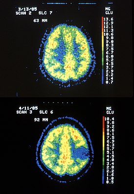 Два ПЭТ изображения: верхнее показывает нормальный мозг, а нижнее — с астроцитомой.