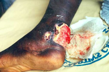 قدم رجل من غانا مصابة بقرحة بورولي