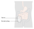 Diagram of an ileostomy with a bag CRUK 030.svg