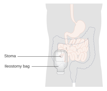 File:Diagram of an ileostomy with a bag CRUK 030.svg