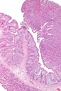 Т-клеточная лимфома, связанная с энтеропатией - low mag.jpg