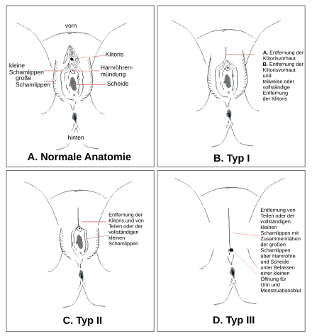 Vagina bilder beschnittene Frauenbeschneidung