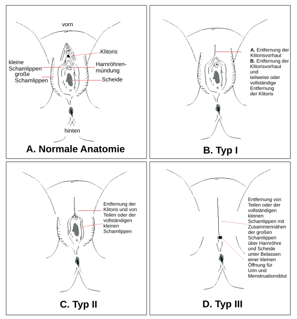 Wikipedia große innere schamlippe Schamlippenpiercing