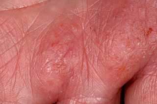 <span class="mw-page-title-main">Hand eczema</span> Skin condition