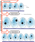 Thumbnail for Hyperplasia