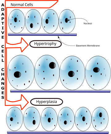 Hiperplasia