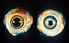 Chicken eyes, showing the appearance in Marek's disease (right) compared with a normal eye (left)