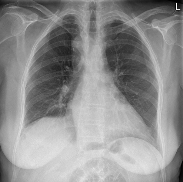 File:Rechts descendierende Aorta - Roe pa.jpg