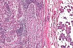 Thumbnail for Sebaceous carcinoma