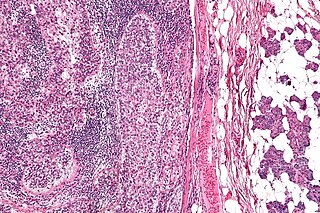 <span class="mw-page-title-main">Sebaceous carcinoma</span> Medical condition