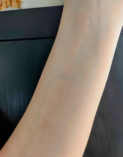 File:Self-harm burns pre-coverup.jpg