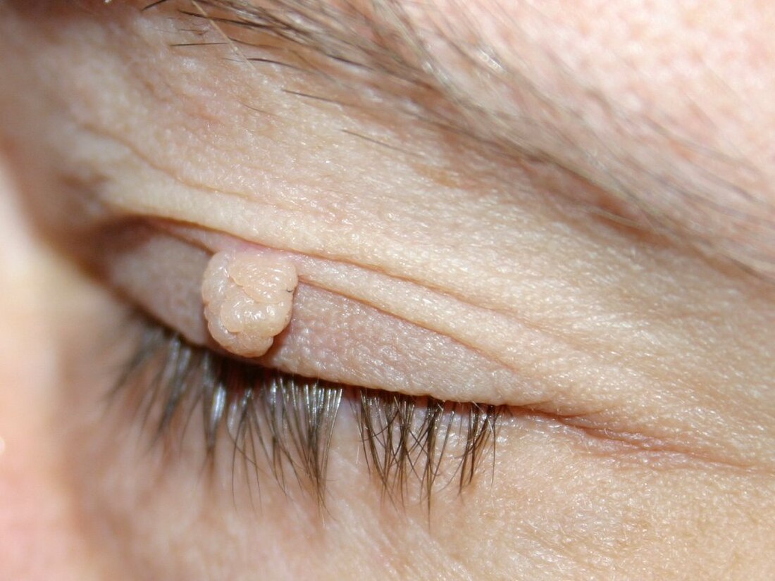 Fibroma