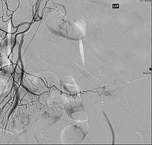 Angiography of a Meckel's diverticulum that presented with bleeding. Angiography of a Meckel's diverticulum that presented with bleeding.jpg