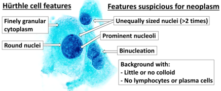 Cytopathology suspicious for Hürthle cell neoplasm (Bethesda category IV, rather than Hürthle cell hyperplasia), Pap stain.[14]