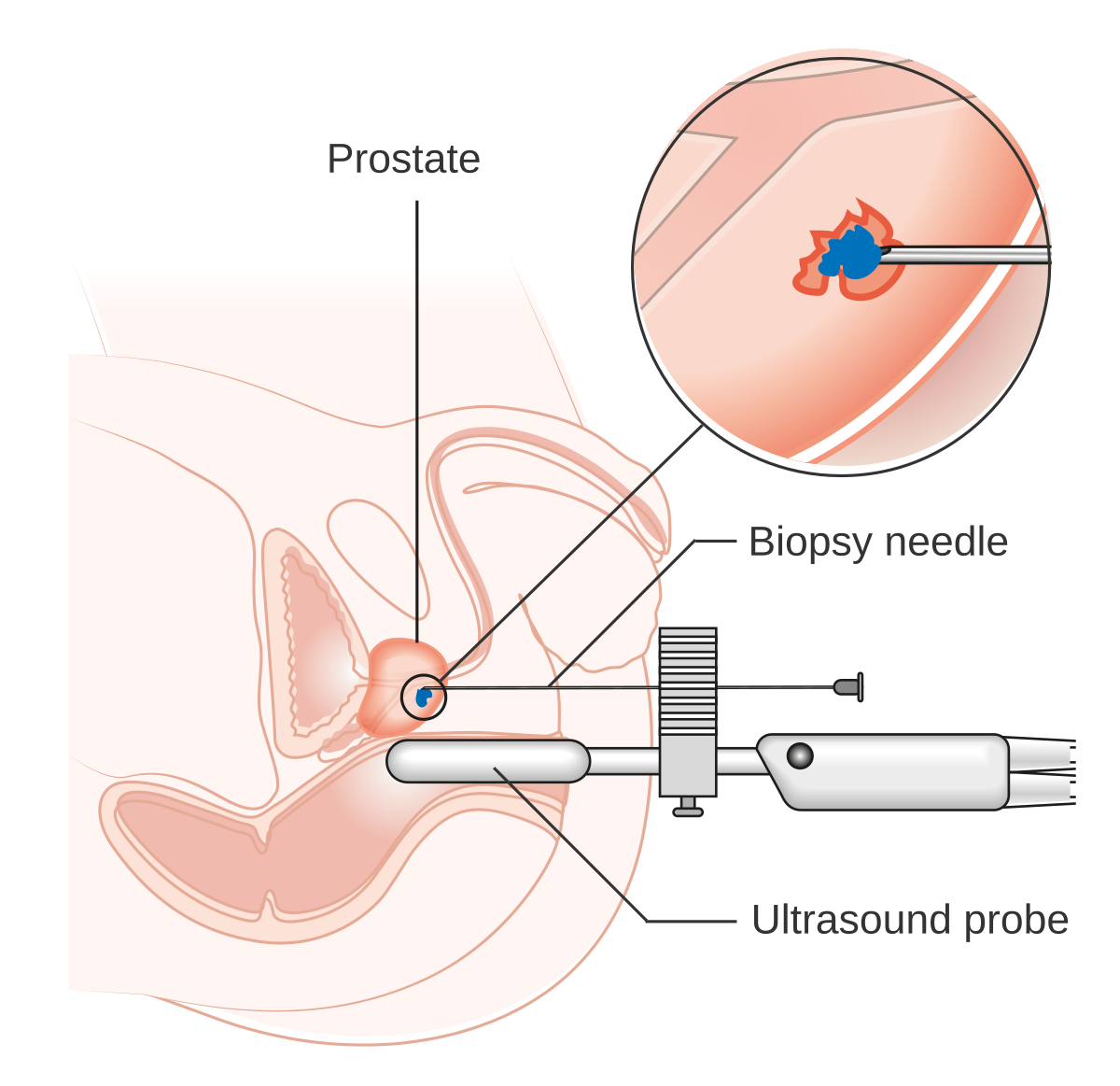 tur prostate biopsy