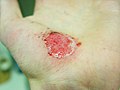Hand Abrasion - 16 hours 45 minutes after injury.JPG