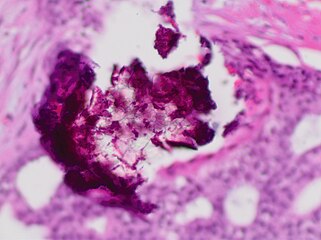 Histopathology of dystrophic microcalcifications in DCIS, H&E stain.