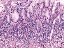 Early acute superficial gastritis: Marked neutrophilic infiltrates appear in the mucous neck region and lamina with a pit microabscess. This case was caused by Helicobacter pylori. Histopathology of early acute superficial gastritis.png