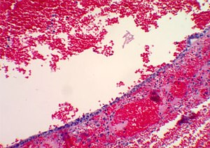 Histopathology of hemorrhagic ovarian cyst