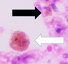 Histopathology of a case of chronic pulmonary congestion, showing interstitium with hemosiderin deposition (black arrow), edema and collagenous thickening. The alveolus contains a siderophage (white arrow, characterized by coarse brown pigment, which is slightly refractile). Histopathology of siderophage in chronic pulmonary congestion.jpg