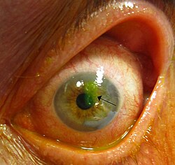 خدش القرنية بعد تلطيخها بـ فلوريسين، وهي علامة خضراء على العين.