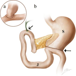 Illustration of Whipple procedure