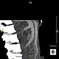 Lateral MIP view in the same patient