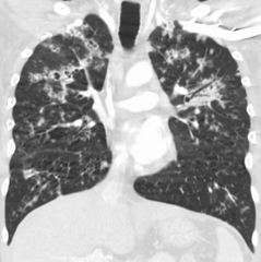 Tuberculosis of the lungs