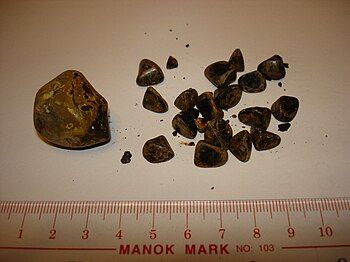 אבני כיס המרה (באנגלית: Gallstones) הן גושים מוצקים הנוצרים בכיס המרה. מרבית האבנים הן אבני כולסטרול (כ-80%) והיתר אבני פיגמנט (קלציום בילירובינט), שחורות או חומות.
