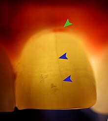 Transillumination of tooth 2.1 showing vertical fracture (blue arrows) and inflammation in marginal gingiva at fracture site (green arrow) Transillumination of tooth marked.jpg