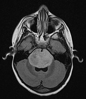 Brainstem glioma Medical condition