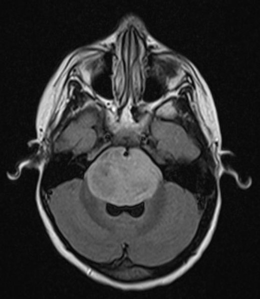 File:Tumor BrainstemGlioma1.JPG