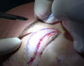 Upper eyelid incision during blepharoplasty