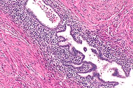 Histopathology of uterine adenomyosis. H&E stain. Uterine adenomyosis -- intermed mag.jpg