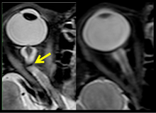 Figure 11: MRI (R+30 days) of the fourth case of visual changes from long-duration spaceflight. Tortuous optic nerve and kink on left (arrow). Control orbit on the right. VIIP Figure 11.png