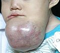 Tracheal intubation is anticipated to be difficult in this child with a massive ameloblastoma