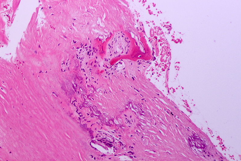 File:Atherosclerosis, HE 8.JPG