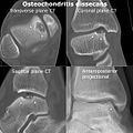剥脱性骨软骨炎患者的距骨（talus）内上侧电脑断层扫描影像（CT）以及膝关节X光（英语：projectional radiography）影像。