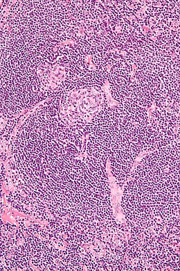 Description de l'image Castleman disease - high mag.jpg.