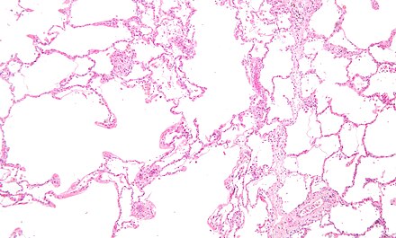 Micrograph showing emphysema  (left – large empty spaces) and lung tissue with relative preserved alveoli (right).