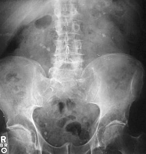 Kidney stones abdominal X-ray.jpg