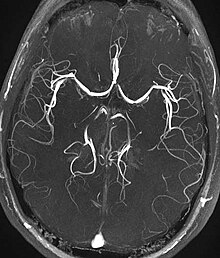 Time-of-flight MRA at the level of the Circle of Willis. Mra-mip.jpg