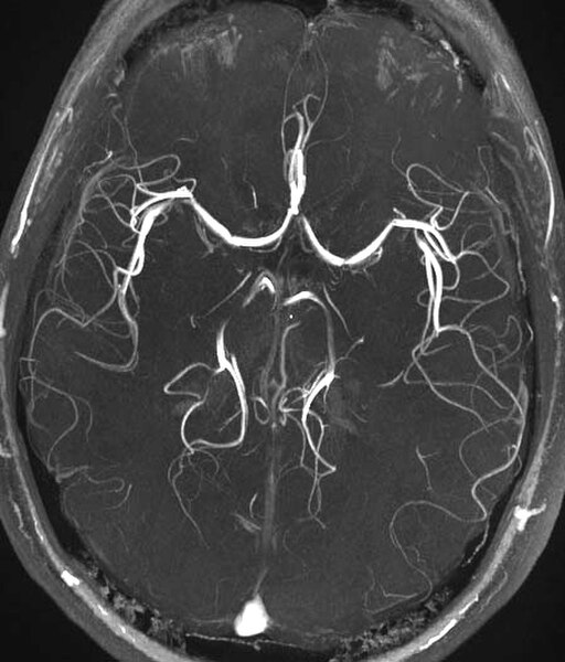 Magnetic resonance angiograph created by the ToF method