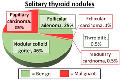 Relative incidences of histopathologic diagnoses of solitary thyroid nodules that have undergone fine needle aspiration. Relative incidences of histopathologic diagnoses of solitary thyroid nodules.png