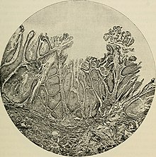 La pathologie et le traitement chirurgical des tumeurs (1895) (14590898559) .jpg