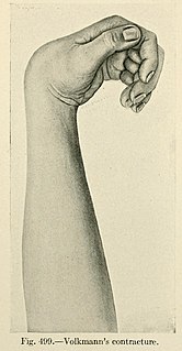 Volkmanns contracture